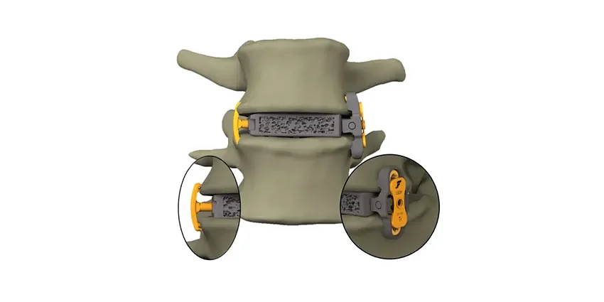 FDA Clears Dr. Betz’s Vertebral Body Replacement Device