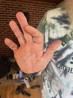 A broken finger and a question on medical insurance