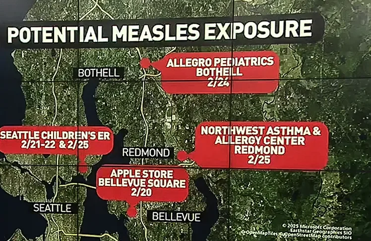 First Measles Case of 2025 Reported In King County, Prompting Health Alerts