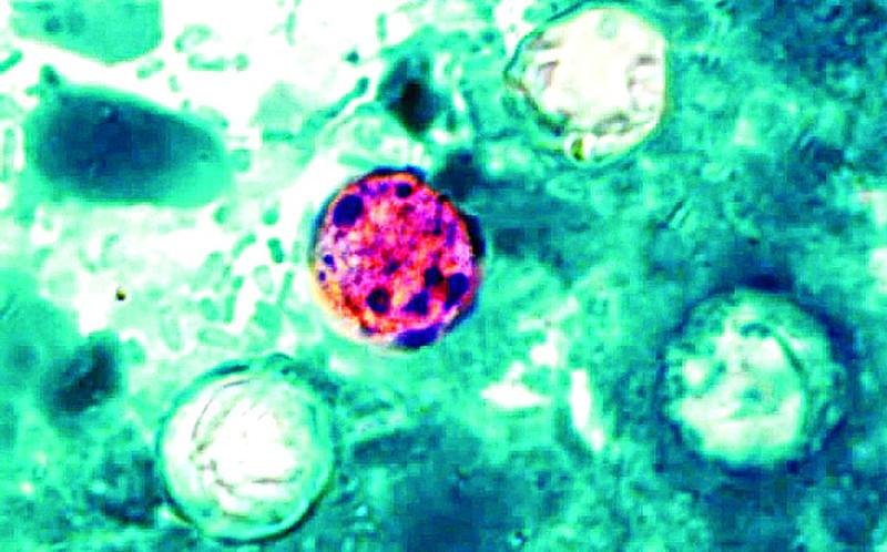 McHenry County tallies 18 suspected cases of cyclospora illness since late June