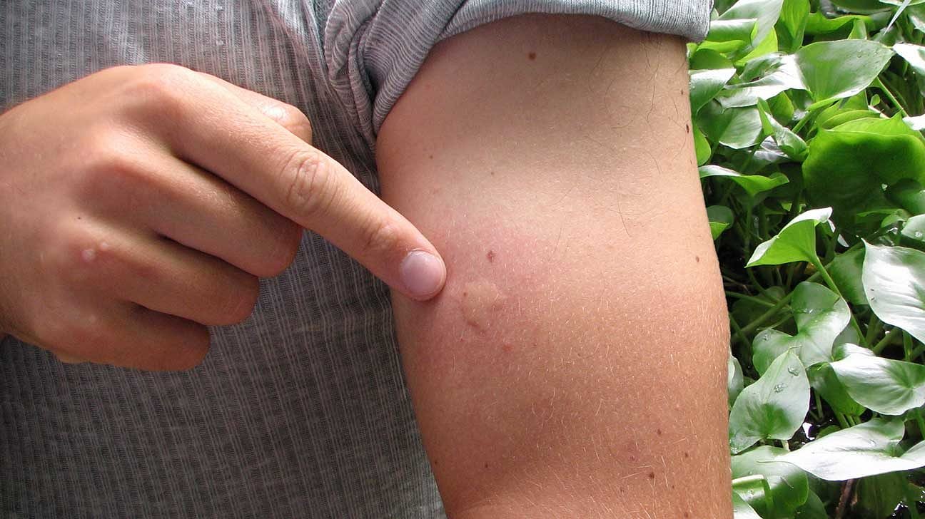 Avertizare de medic: simptomele după înțepătura de țânțar care pot ascunde virusul West Nile