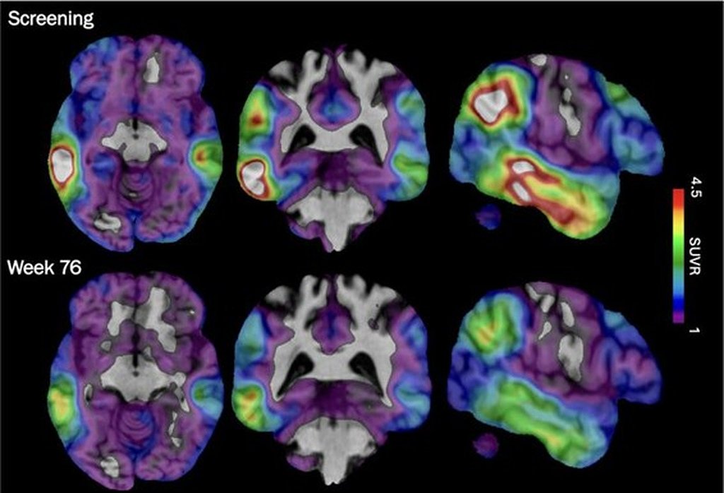 An experimental Alzheimer's drug shows some promise as researchers hunt new approaches