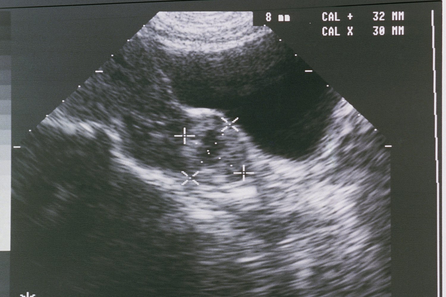 Ectopic pregnancy deaths have nearly doubled. It’s worse in states, like Texas, with abortion bans.