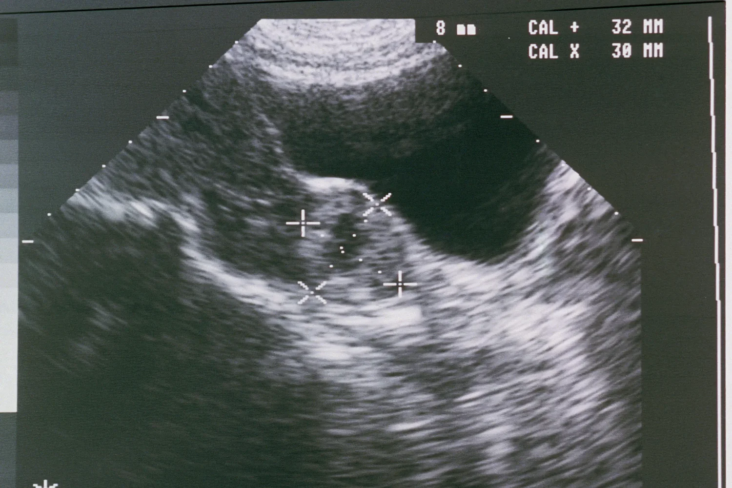 Ectopic pregnancy deaths have nearly doubled. It’s worse in states, like Texas, with abortion bans.