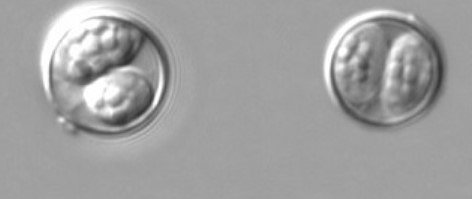 Cyclosporiasis outbreak symptoms: Foods to avoid as ‘explosive diarrhea’ parasite spreads