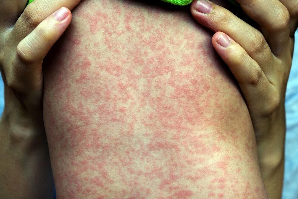 Measles case confirmed in Kane County; Health Department investigating potential exposures