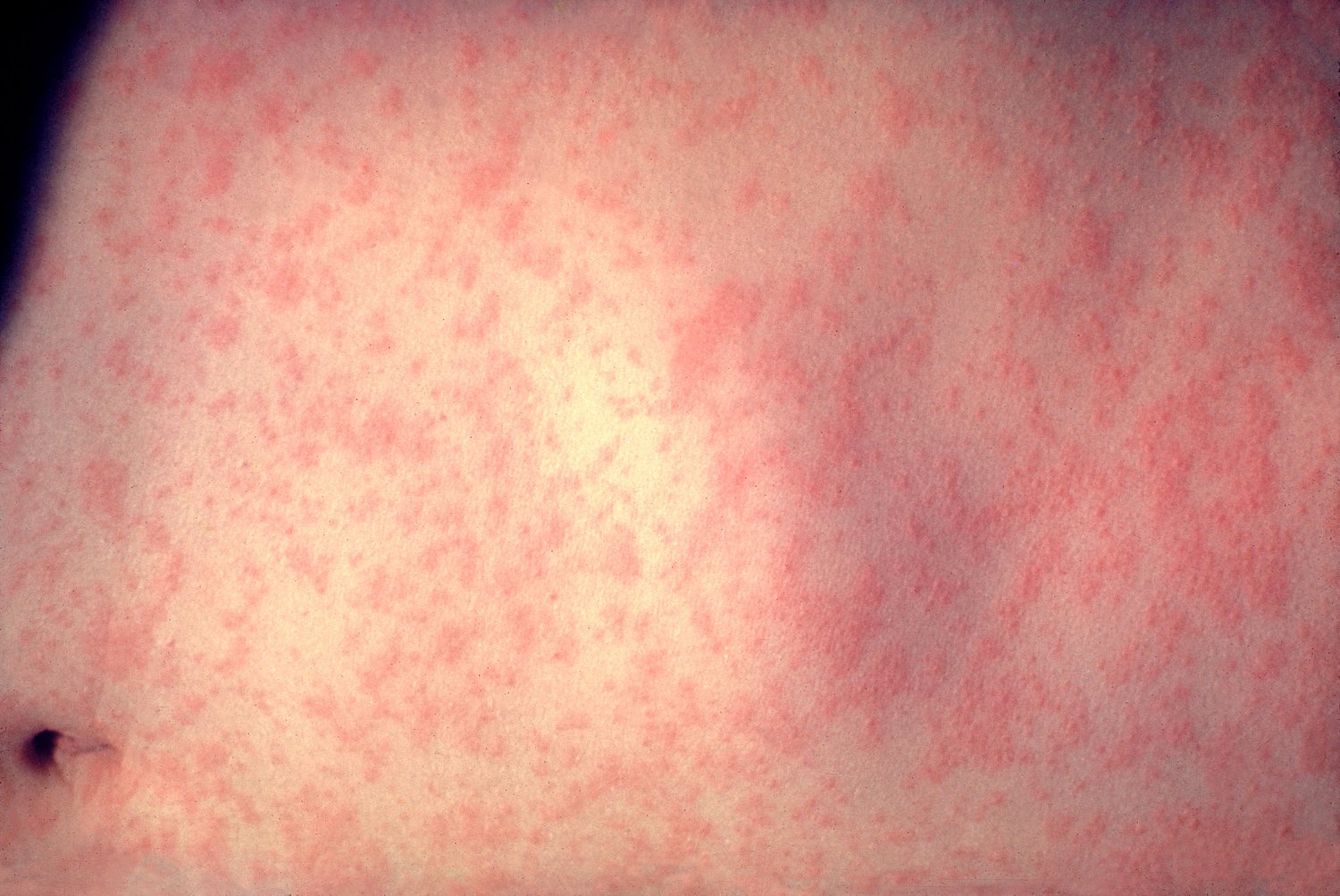 Central Pa. woman dies after contracting measles, coroner says