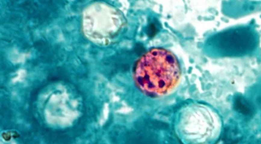 11 cases of cyclosporiasis confirmed in Alabama amid national outbreak