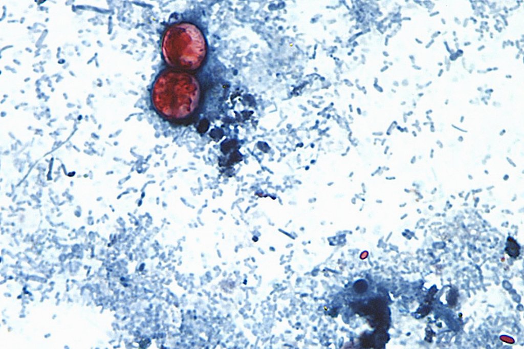 Michigan reports first 2 US deaths in outbreak of cyclospora