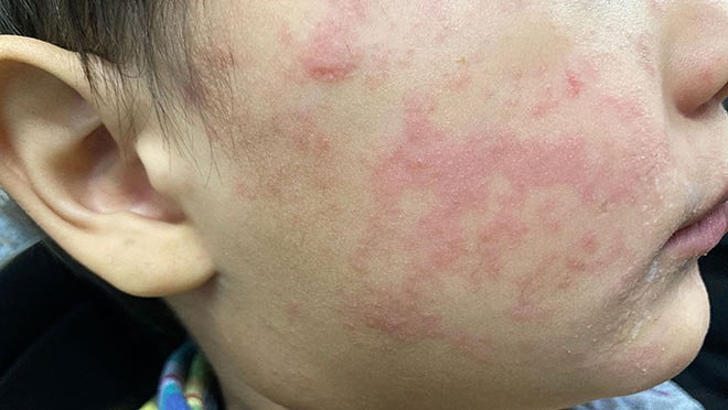 45 measles cases reported this year in Oregon, well above previous peak year