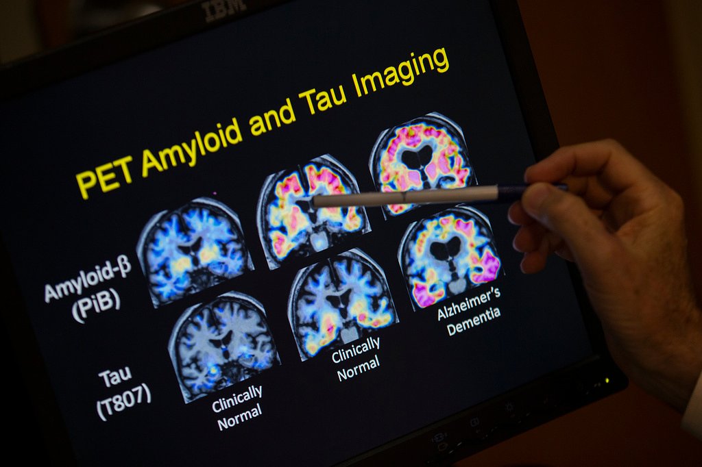 Want to lower your risk of dementia? It doesn't involve a blood test