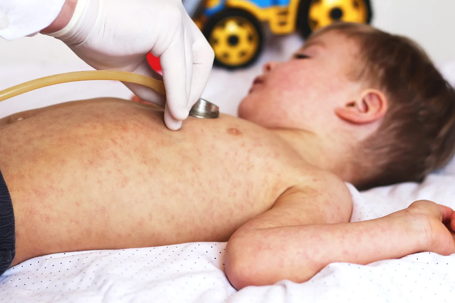 No, la vitamina A no previene el sarampión